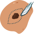 Skin Lesion Excisions
